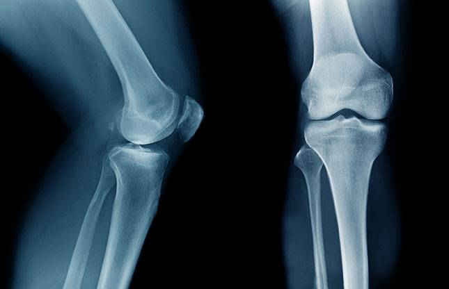 Vitamin K2 and bone health